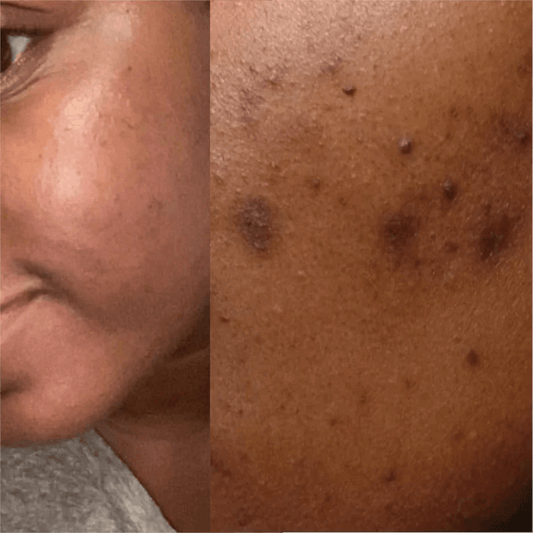 The Ultimate Routine For Dark Spots