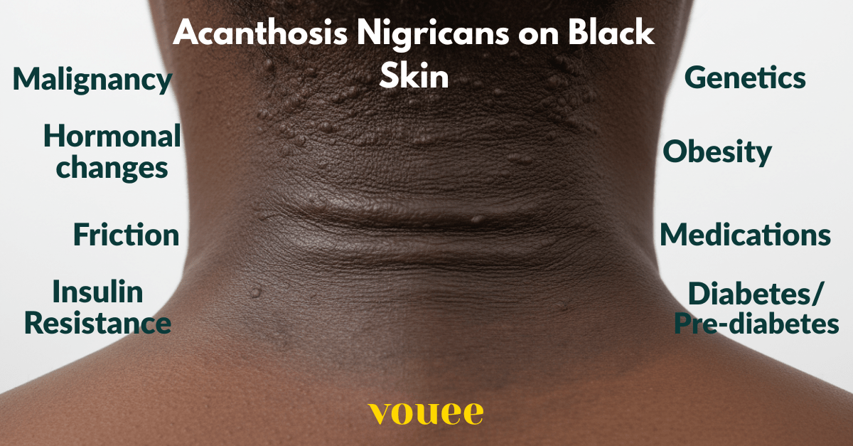 Acanthosis Nigricans on Black Skin: Causes & Safe Fading Guide