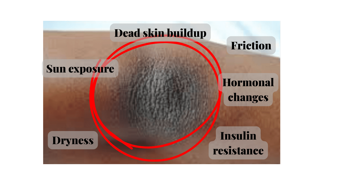 Dark Knees & Elbows on Black Skin: Causes & Safe Fading Guide