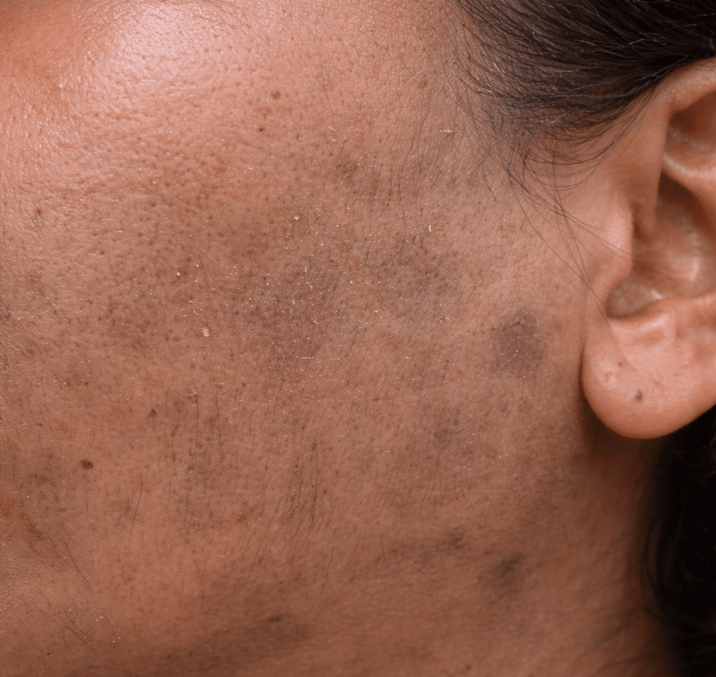 8 Common Mistakes Making Your Dark Spots Return Stronger Over 30