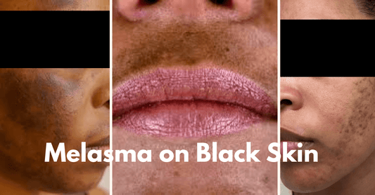 Melasma in Darker Skin: Causes, Triggers, and Safe Treatments