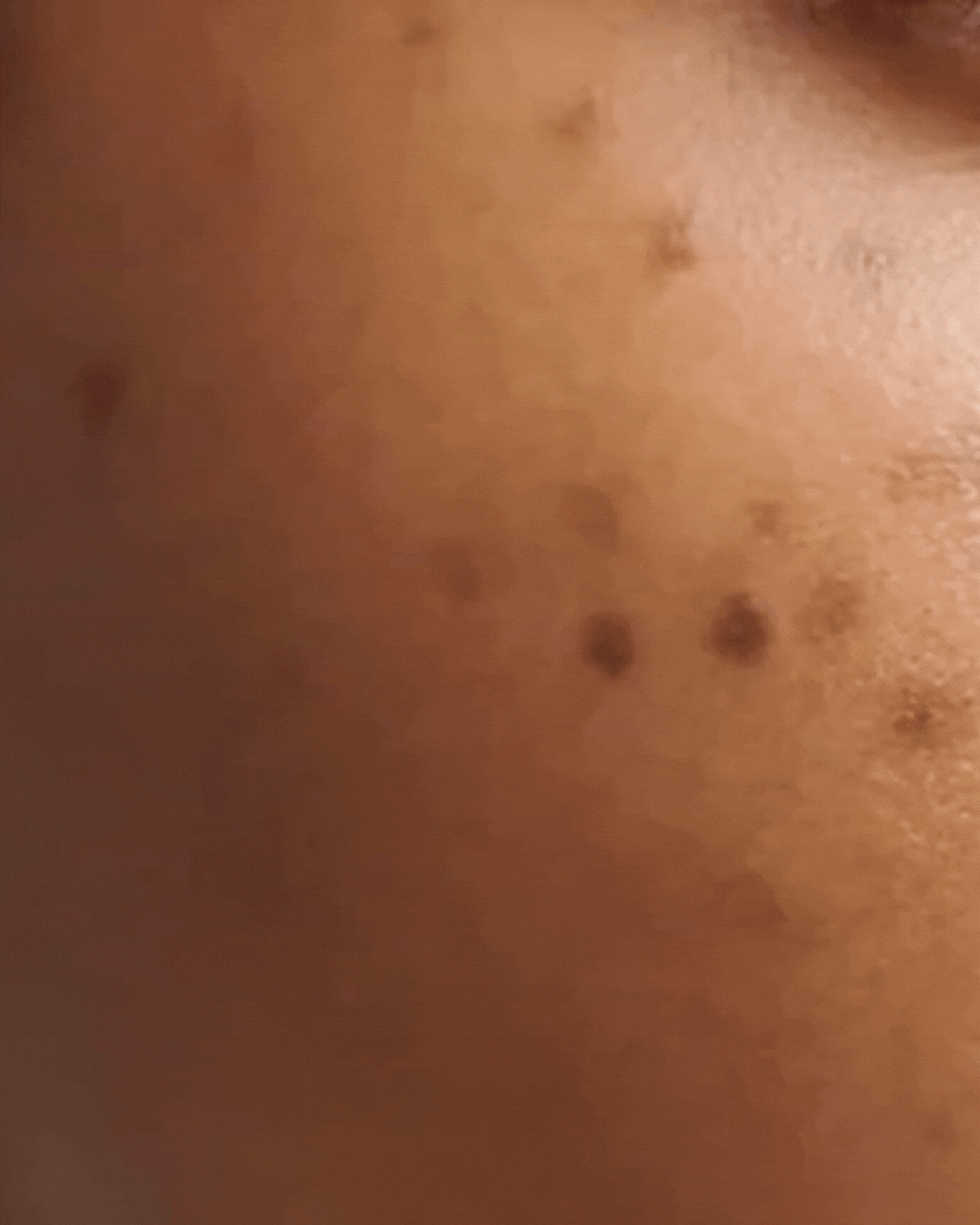 VOUEE Animation showing melani-rich skin and hyperpigmentation and dark spots
