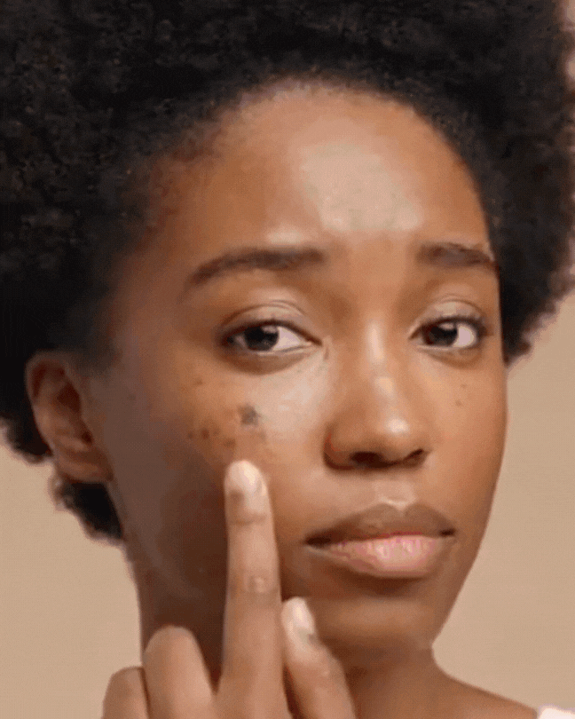 melanin-rich skin with hyperpigmentation and dark spots, Post-Inflammatory Hyperpigmentation (PIH) stages