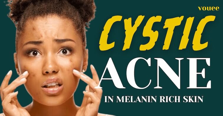 Cystic Acne in Melanin-rich skin