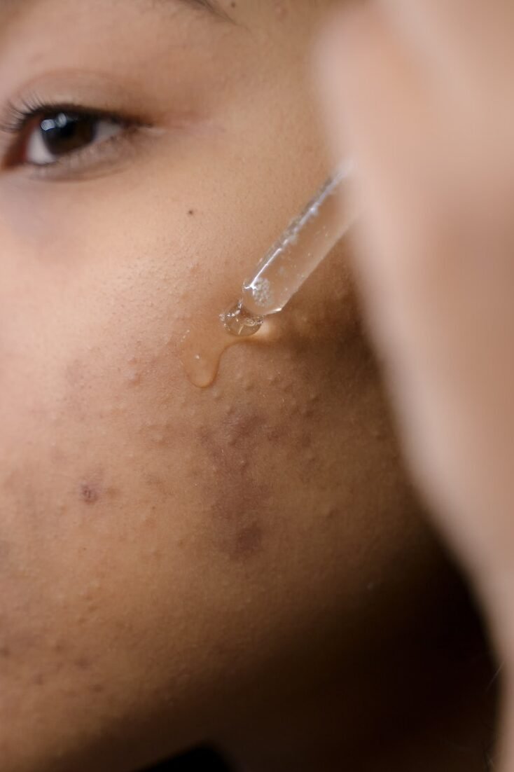dark spots in black skin