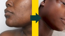 How To Correct and Remove Dark Spots on Your Face